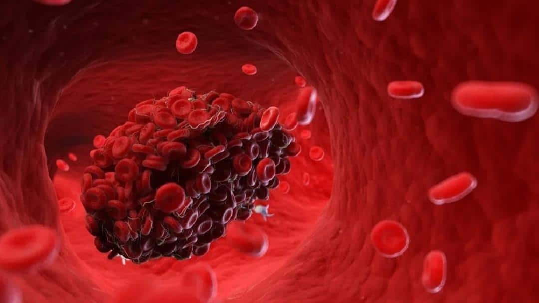 غلظت خون و ارتباط تشدید غلظت با واکسن کرونا 