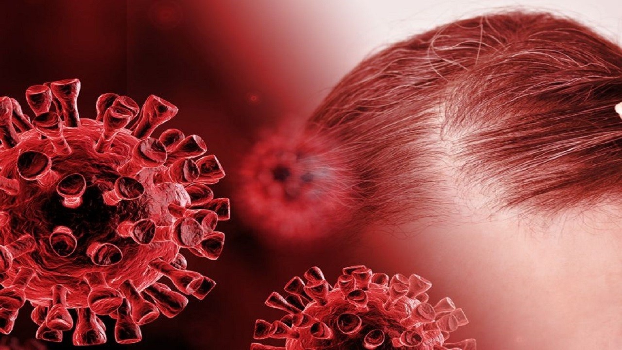 آیا واکسن کرونا  باعث ریزش مو می شود؟ بررسی ارتباط علمی با ریزش موی کلی و سکه‌ای